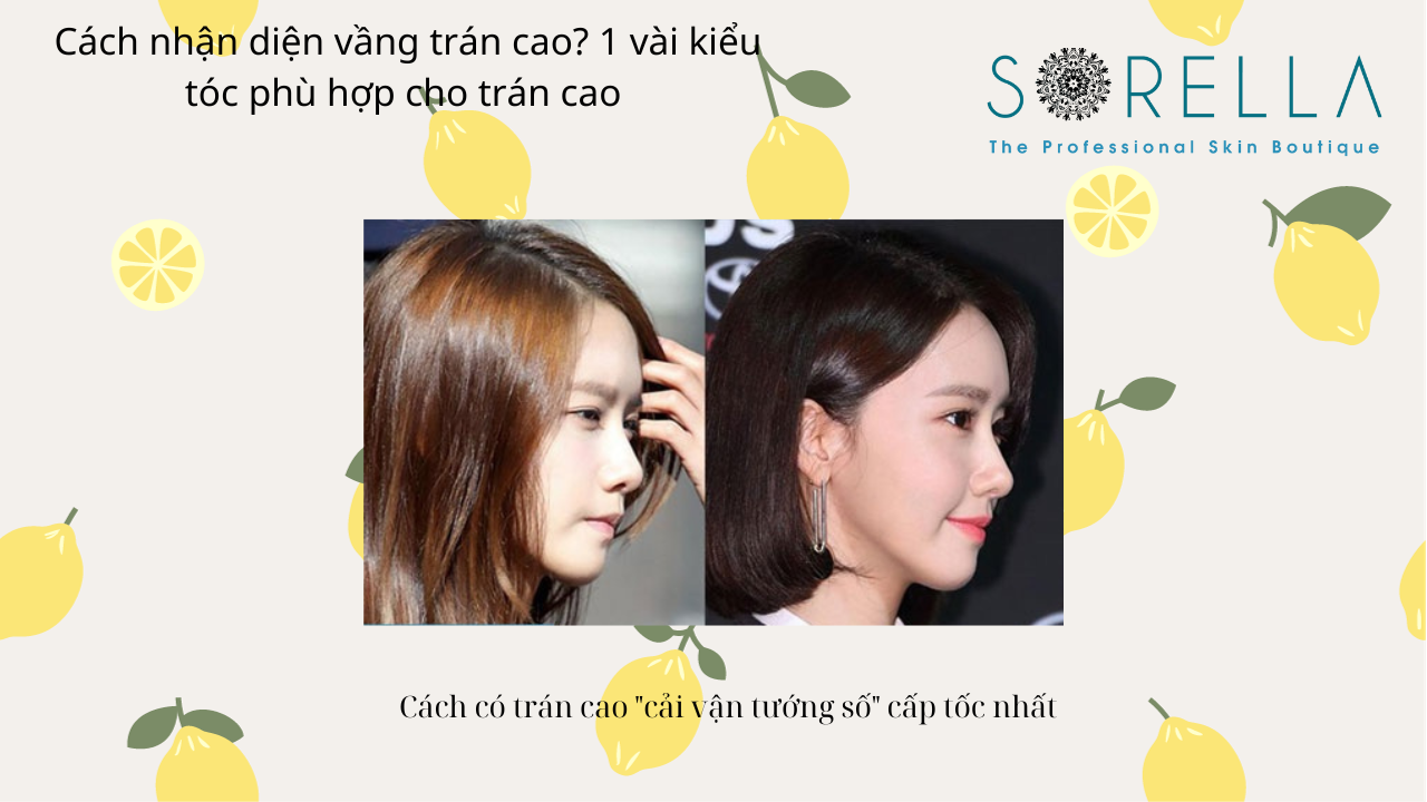 Cách nhận diện vầng trán cao?