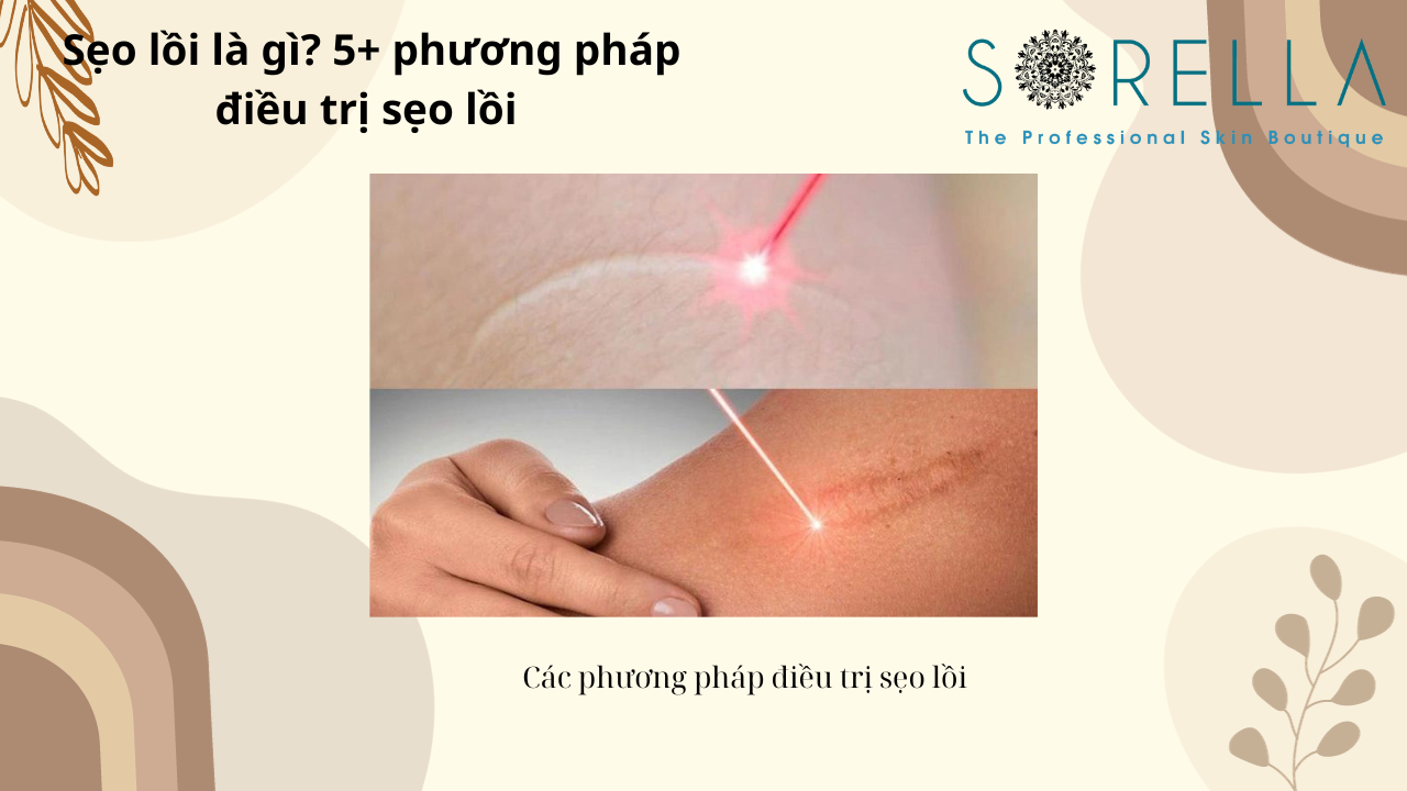 Sẹo lồi là gì?