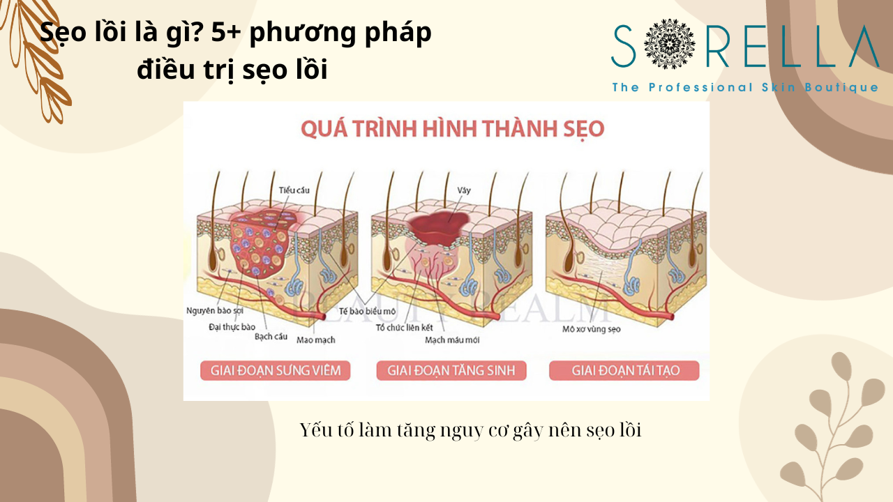 Sẹo lồi là gì?