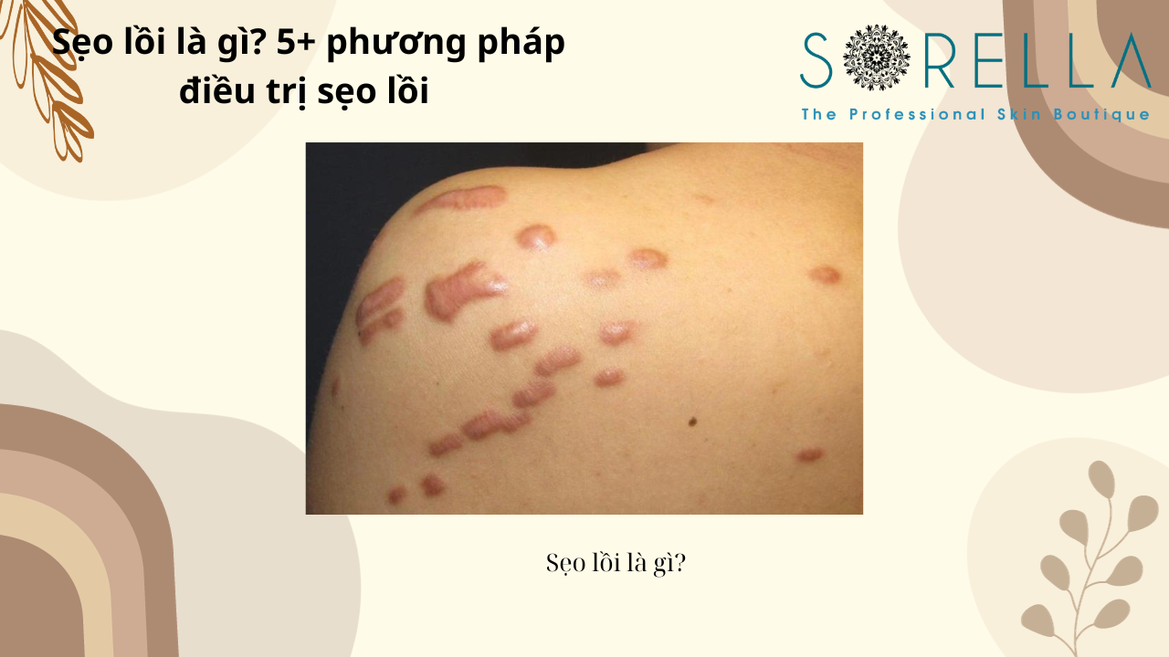 Sẹo lồi là gì?