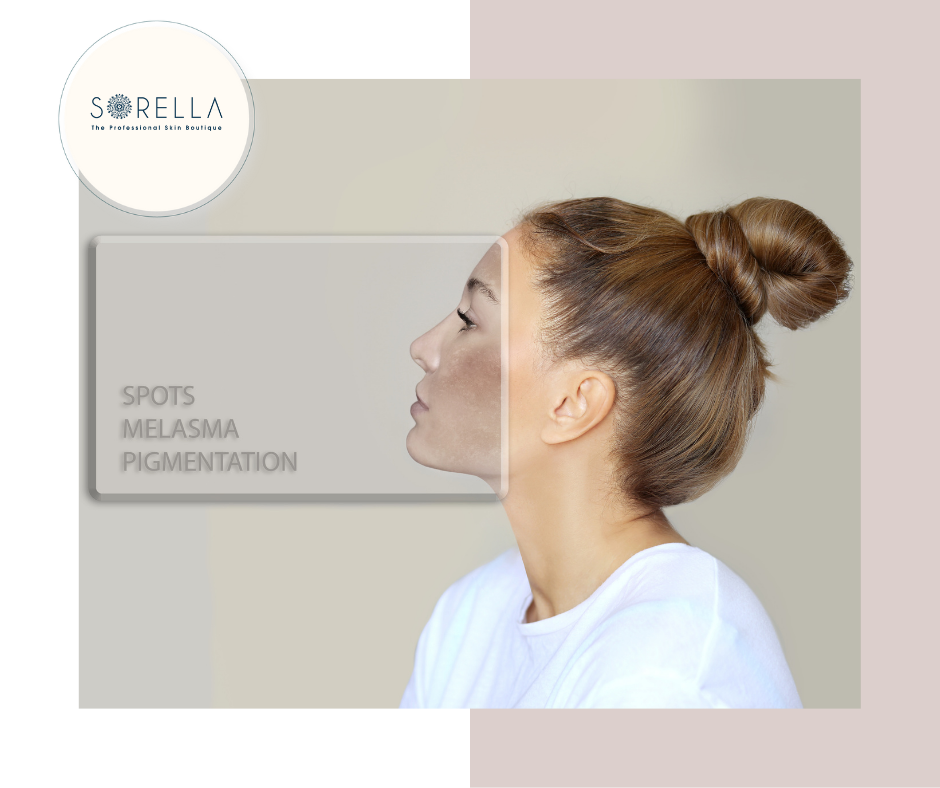 How to Reduce Melasma Formation?