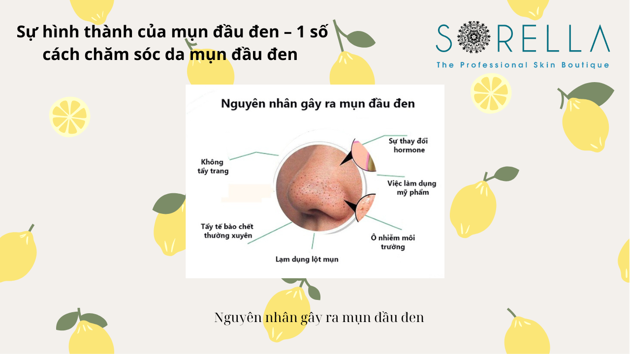 Sự hình thành của mụn đầu đen