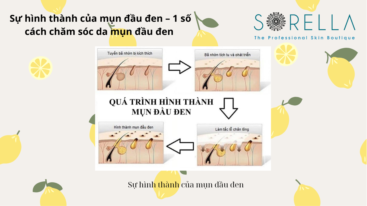 Sự hình thành của mụn đầu đen
