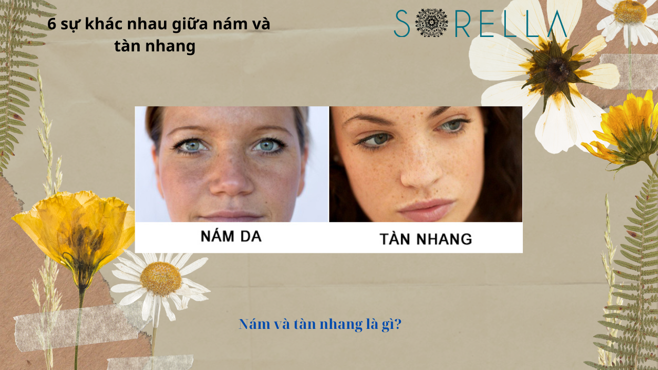 Sự khác nhau giữa nám và tàn nhang