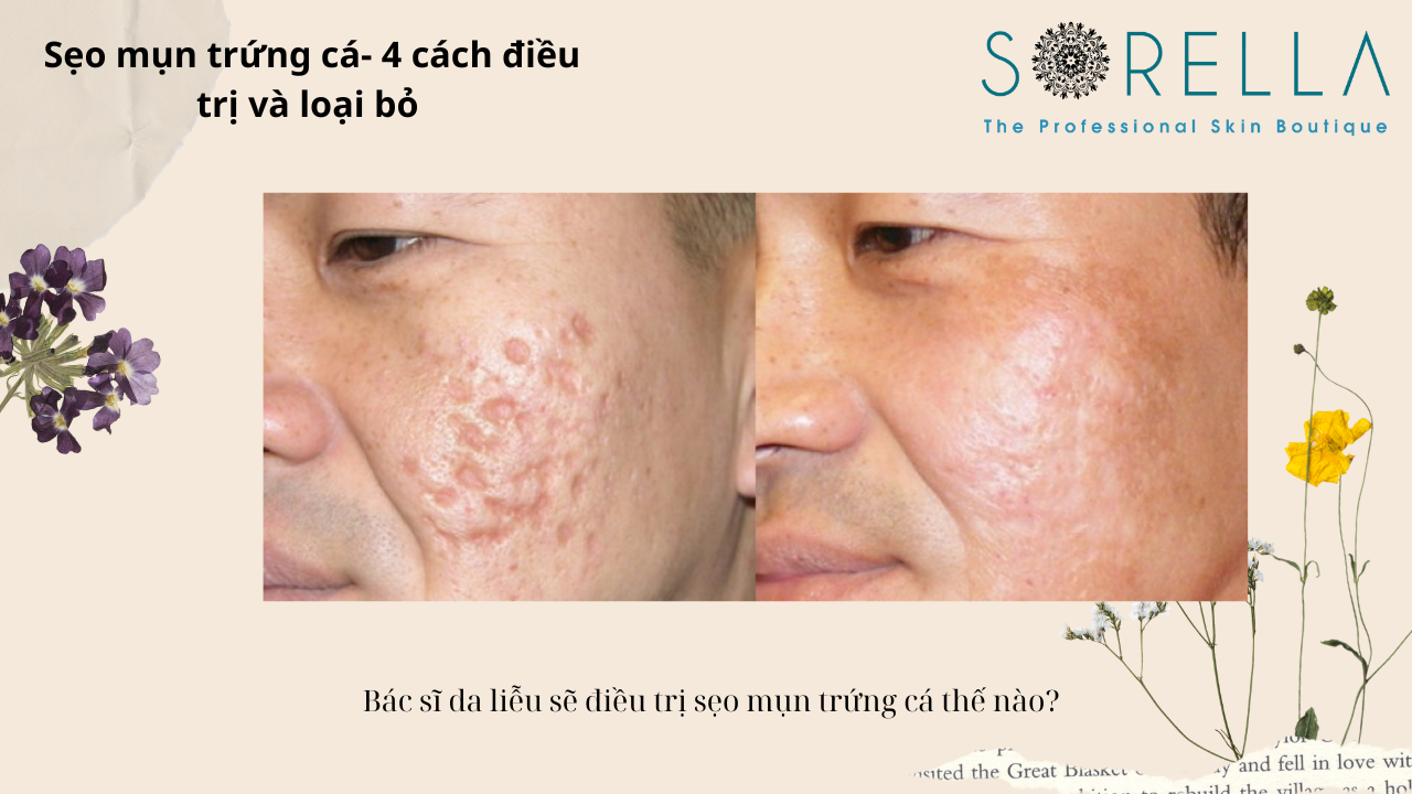Sẹo mụn trứng cá