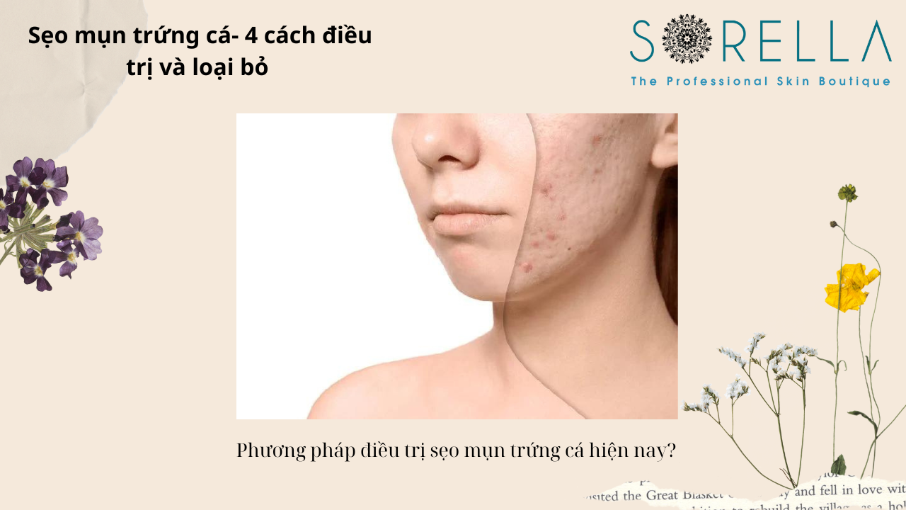 Sẹo mụn trứng cá