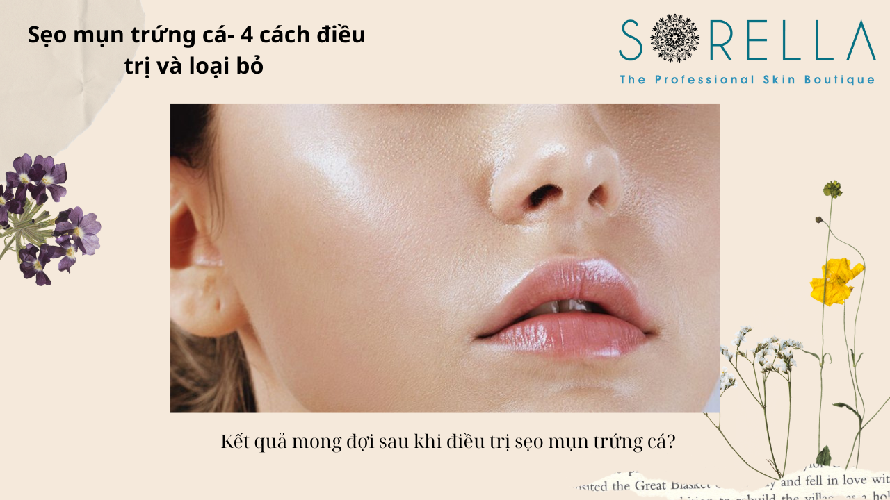 Sẹo mụn trứng cá