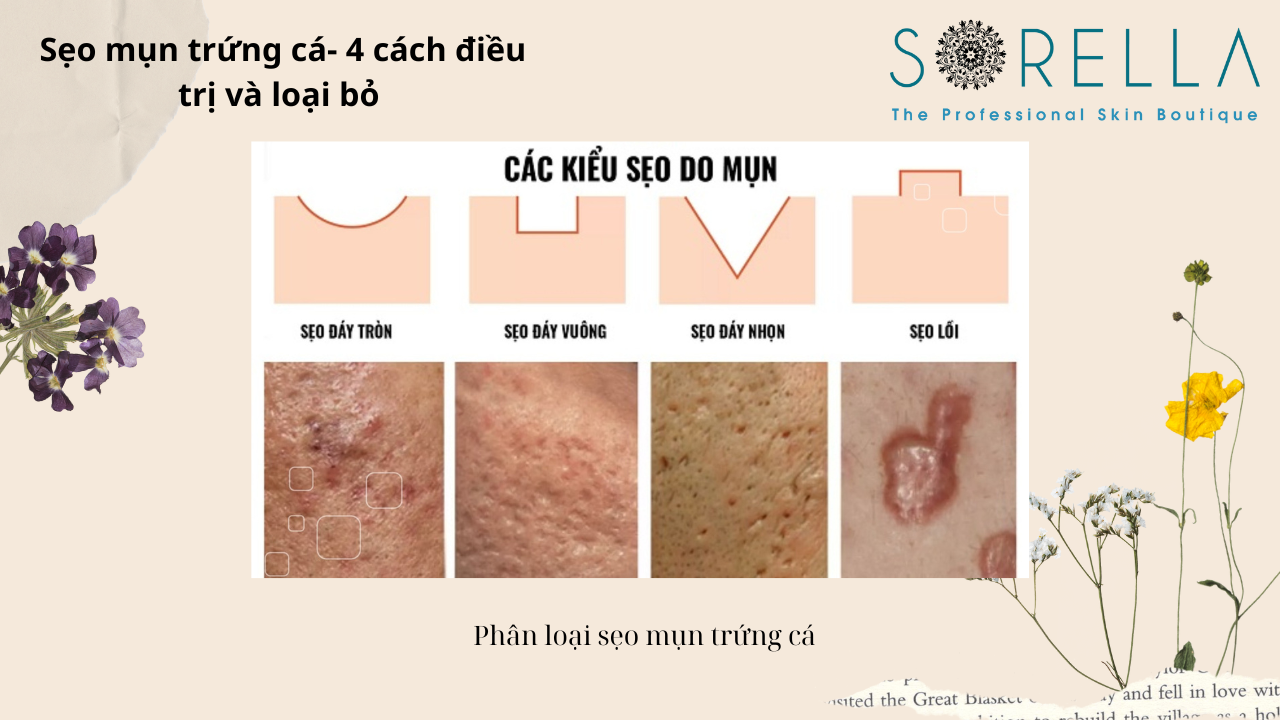 Sẹo mụn trứng cá