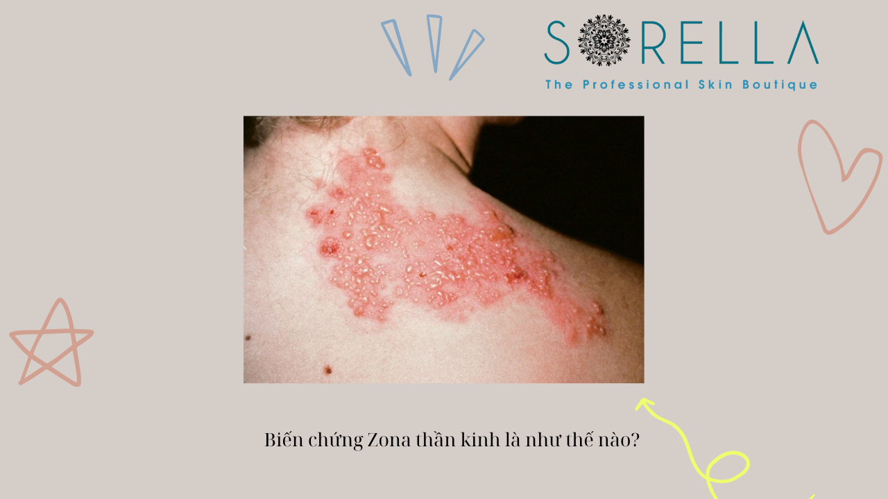 Biến chứng zona thần kinh