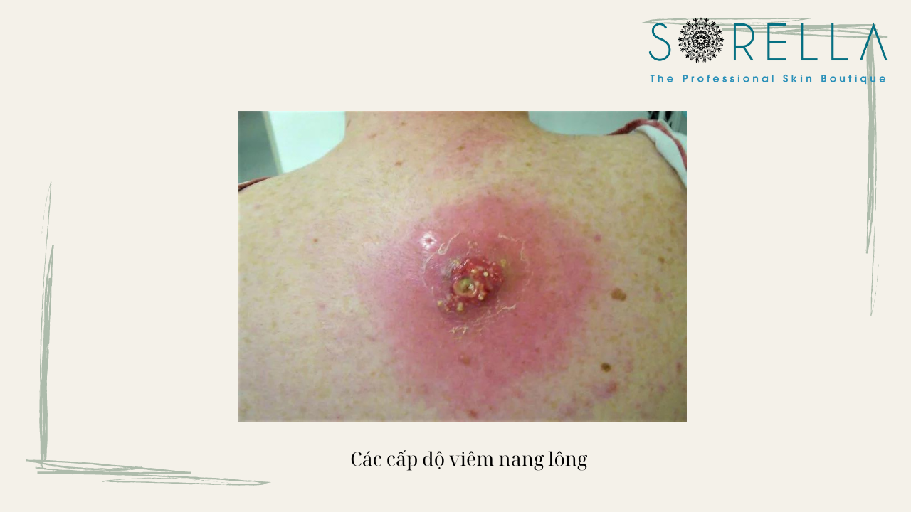 Viêm nang lông lả gì? 