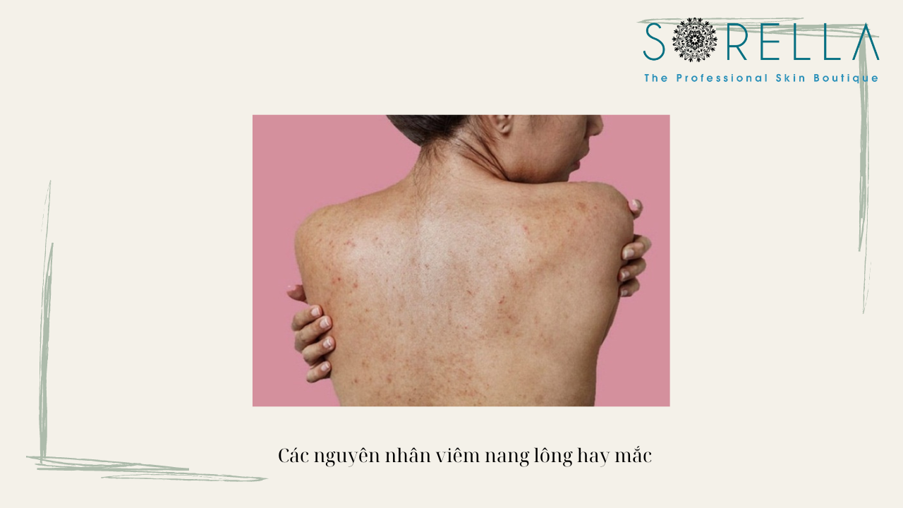 Viêm nang lông lả gì? 