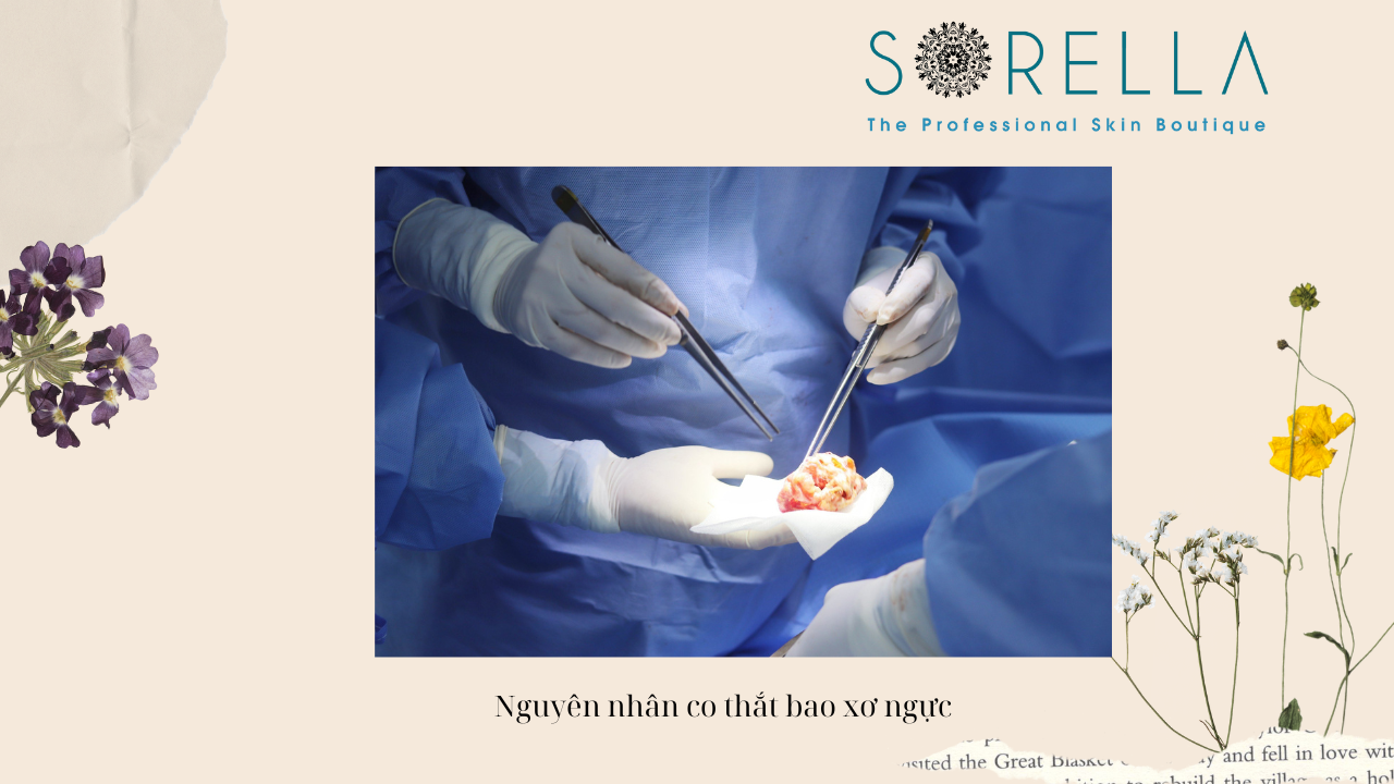 Co thắt bao xơ sau nâng ngực