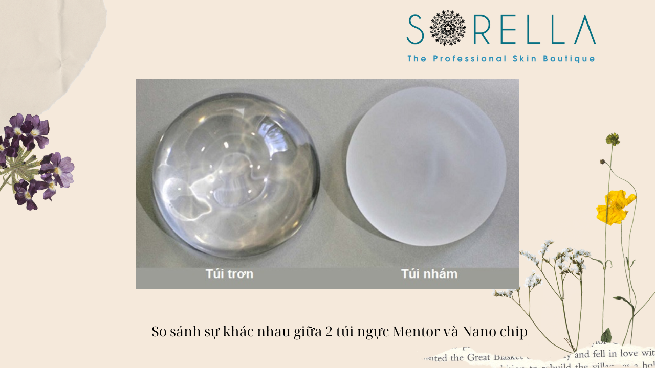 Nên nâng ngực Mentor hay Nano chip? 