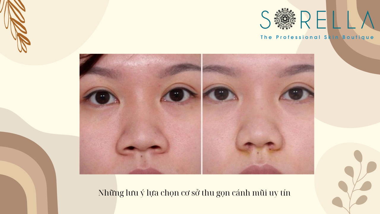 Cuộn cánh mũi là gì?