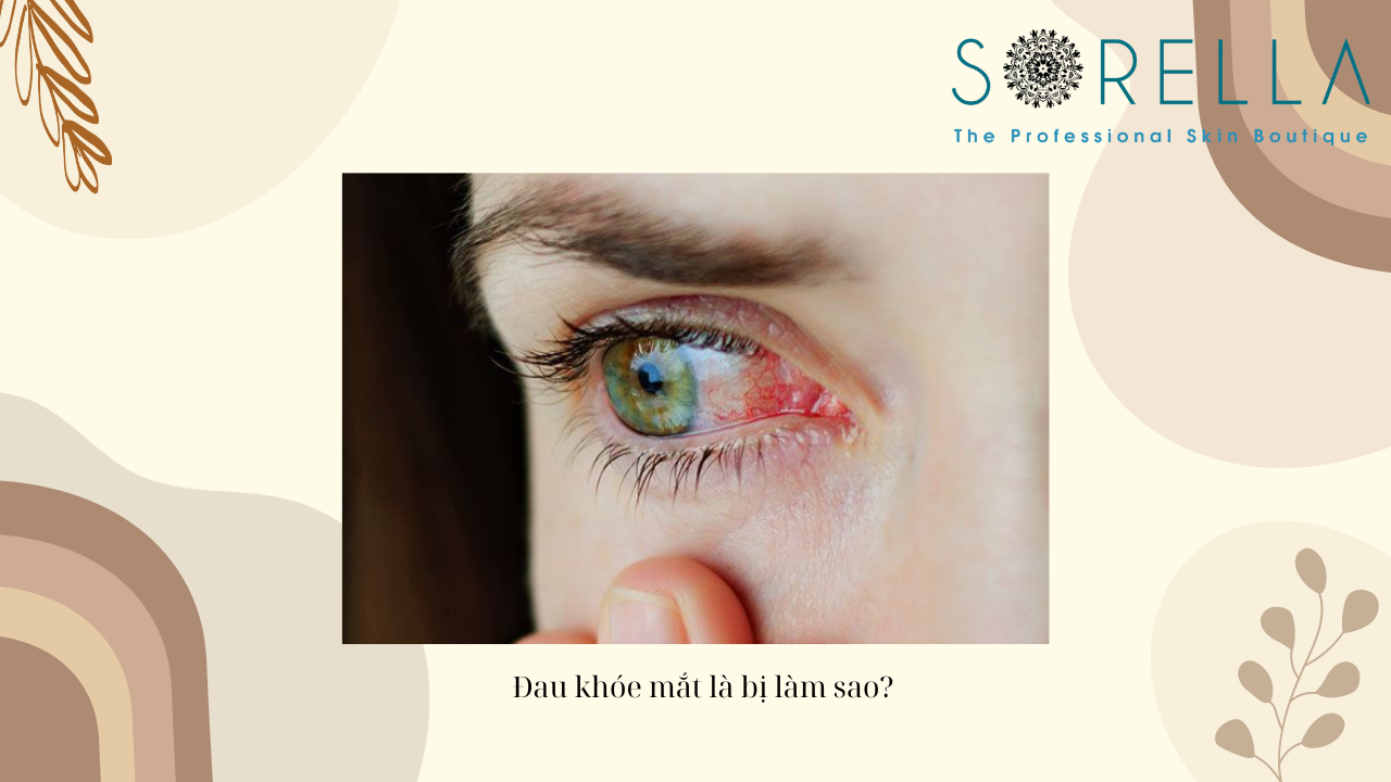 Đau khóe mắt là bị làm sao?