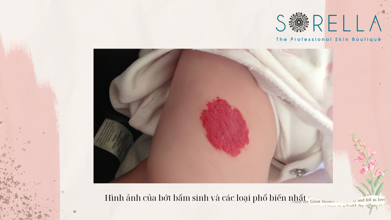 Có thể xoá bớt đen bẩm sinh không?