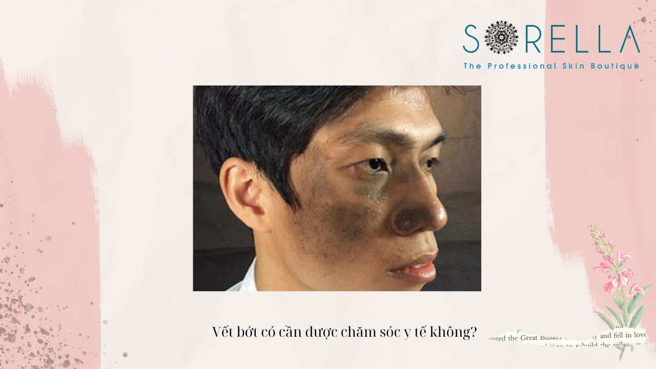 Có thể xoá bớt đen bẩm sinh không?