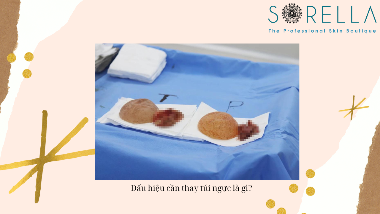 Dấu hiệu cần thay túi ngực 