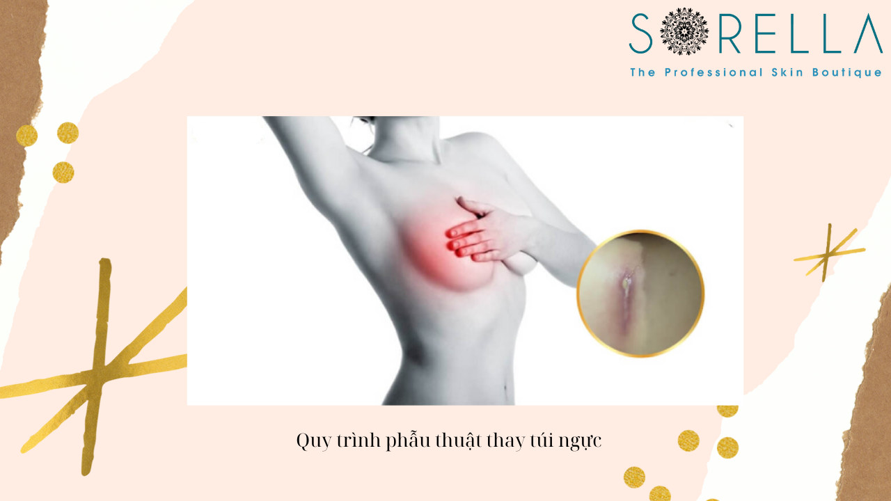 Dấu hiệu cần thay túi ngực 