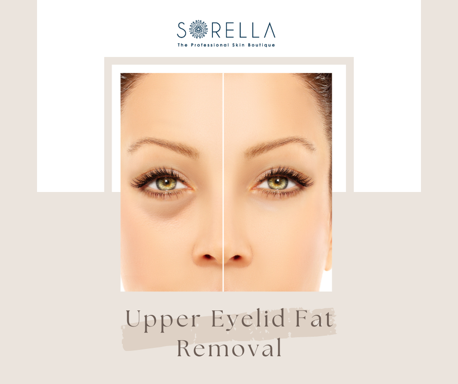 Should You Get Upper Eyelid Fat Removal?