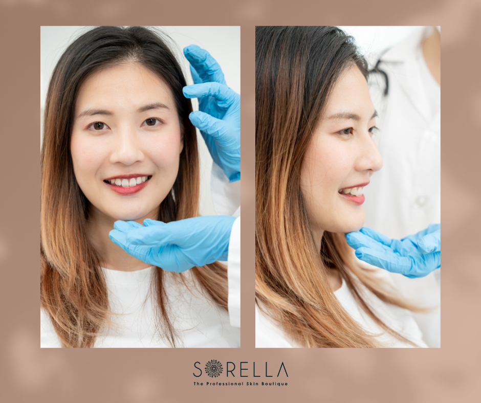 What is smile surgery?