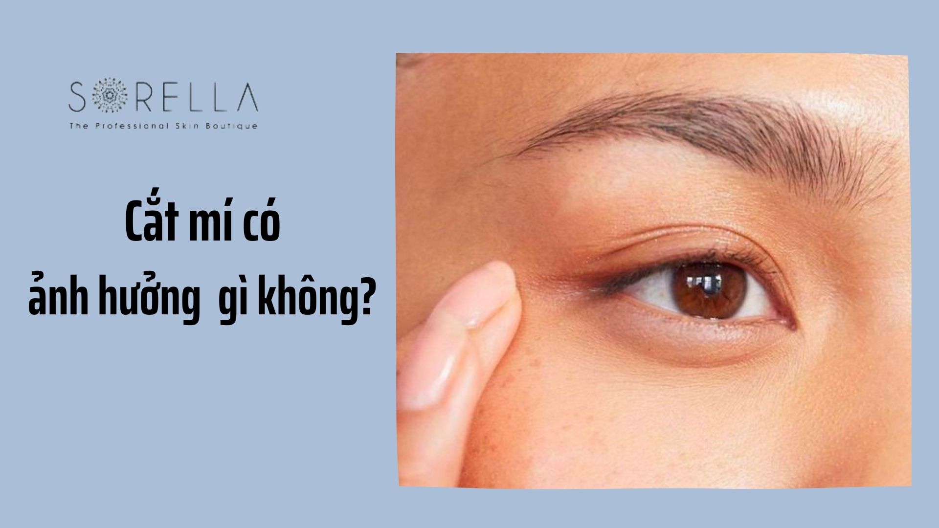 5 câu hỏi thường gặp khi phẫu thuật cắt mí