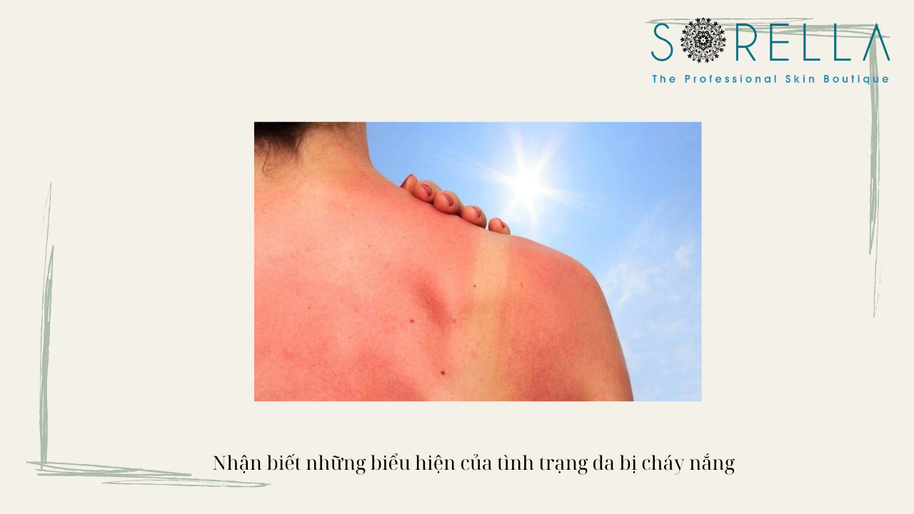 Bỏ túi ngay 5 tips phục hồi da cháy nắng 
