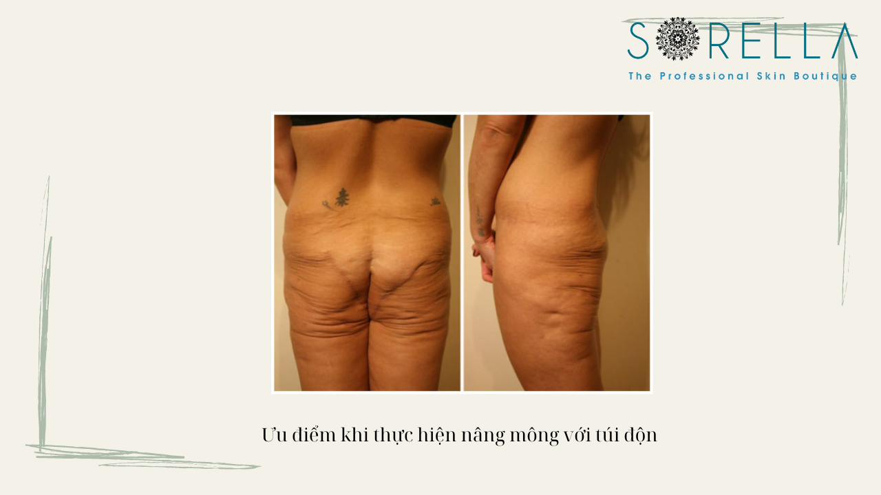 Thế nào là nâng mông bằng túi độn? 