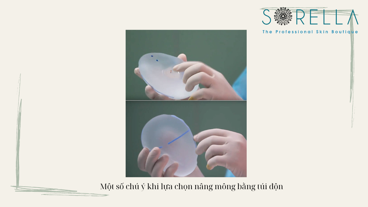 Thế nào là nâng mông bằng túi độn? 