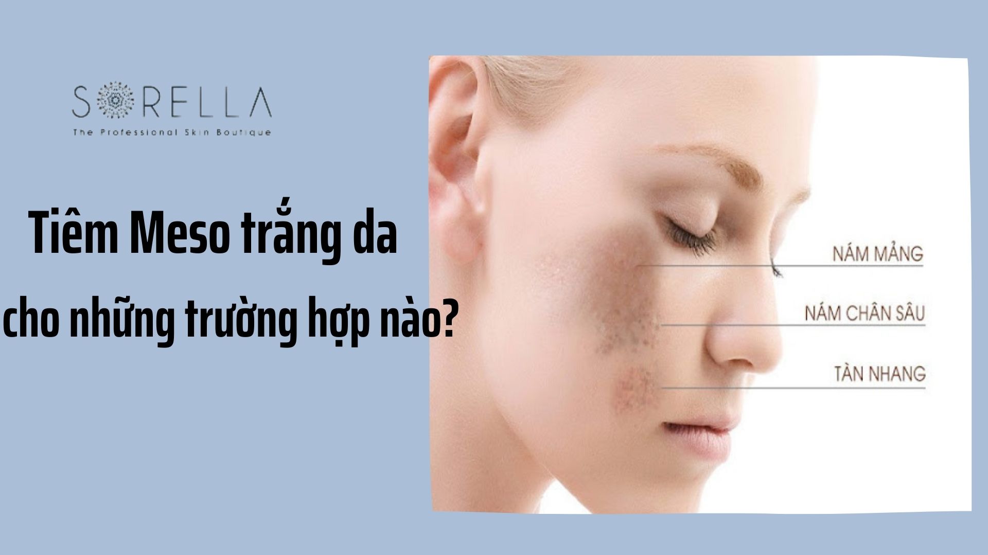 5 câu hỏi hay gặp khi tiêm Meso trắng da