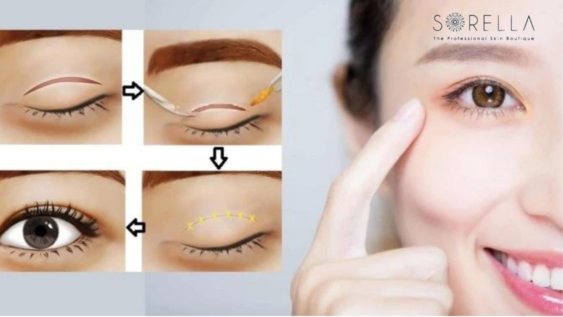 5 câu hỏi thường gặp khi phẫu thuật cắt mí