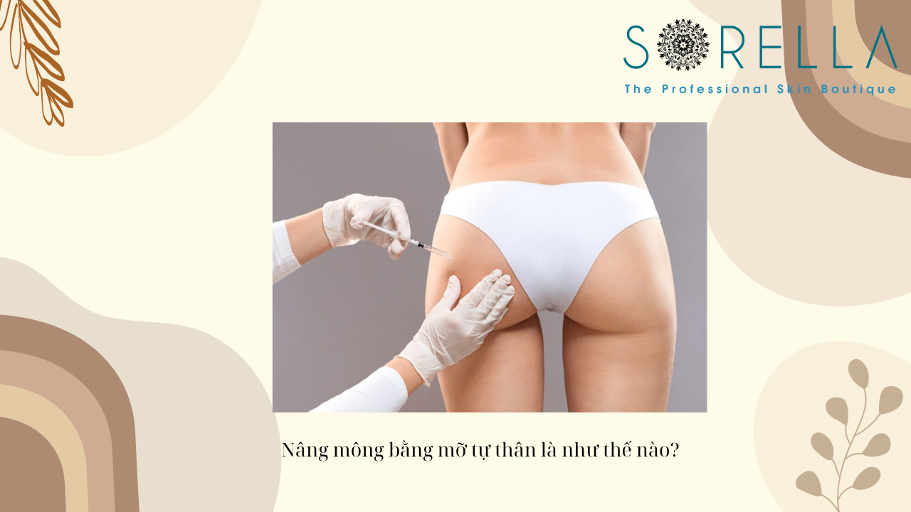 Nâng mông bằng mỡ tự thân là như thế nào? 