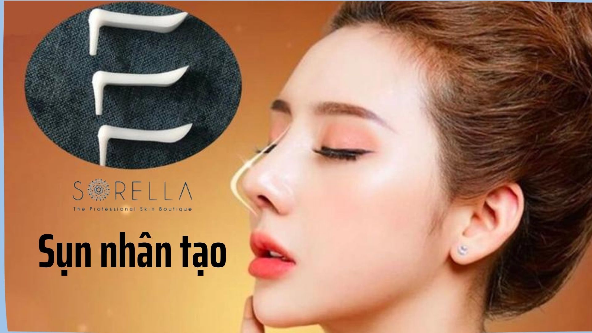 2 loại sụn mũi phổ biến khi nâng mũi