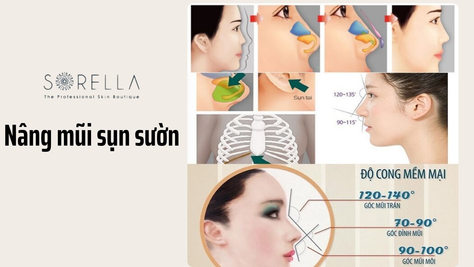2 loại sụn mũi phổ biến khi nâng mũi