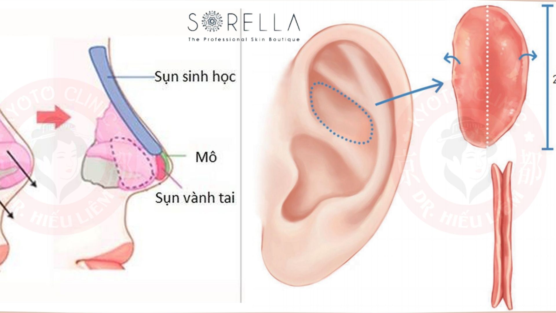 Nâng mũi cấu trúc và 3 loại sụn nâng mũi tốt nhất
