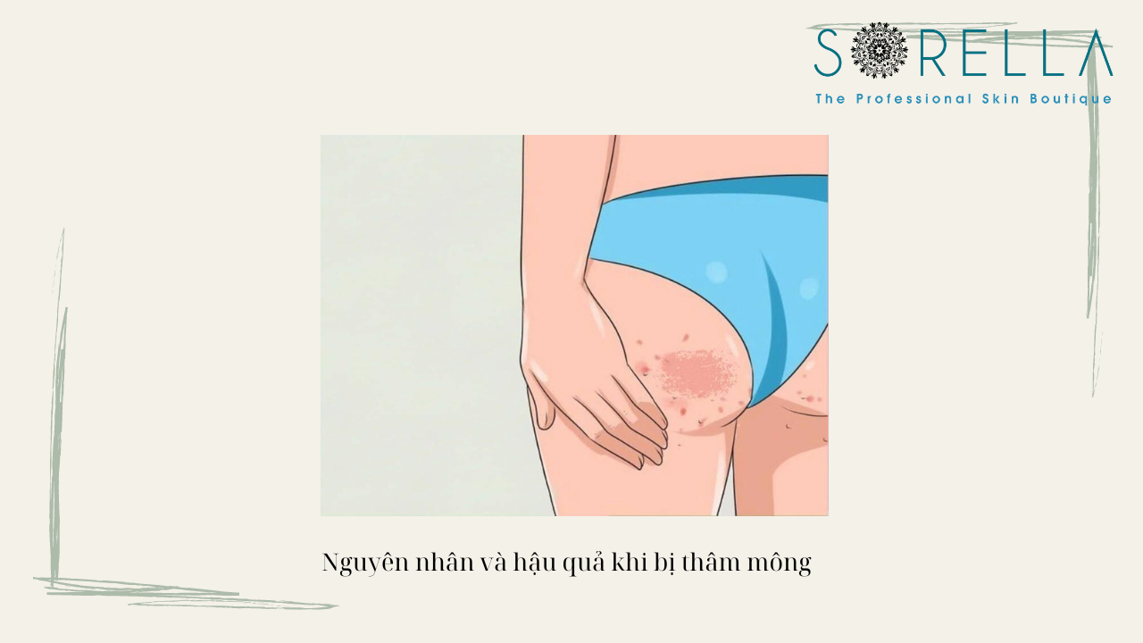 Cách trị thâm mông cấp tốc
