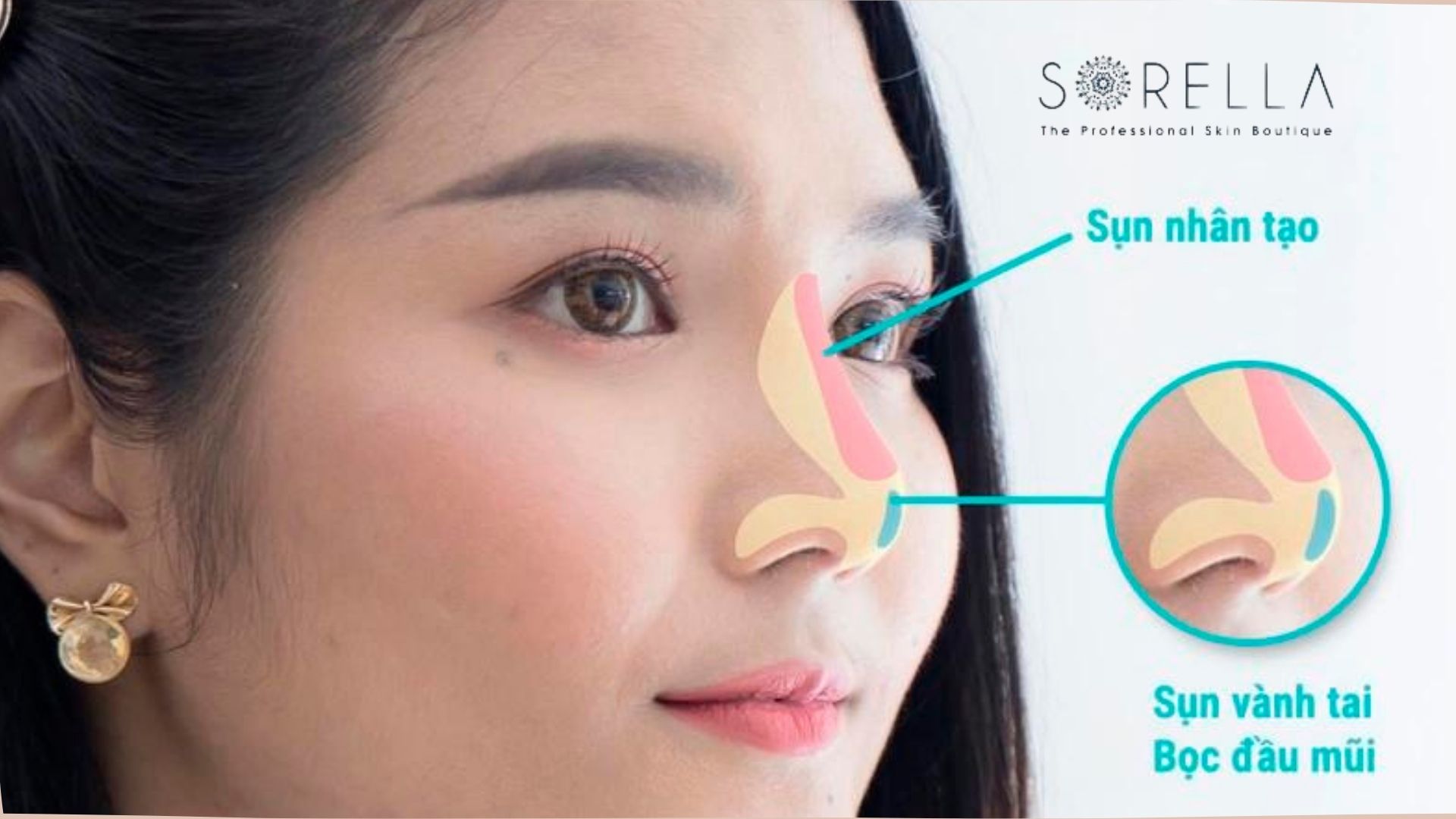 2 loại sụn mũi phổ biến khi nâng mũi