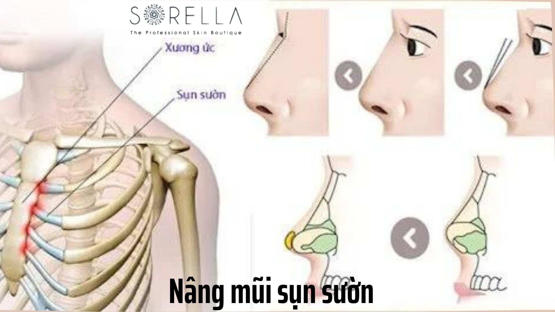 3 Công nghệ nâng mũi Hàn Quốc được áp dụng thành công nhất