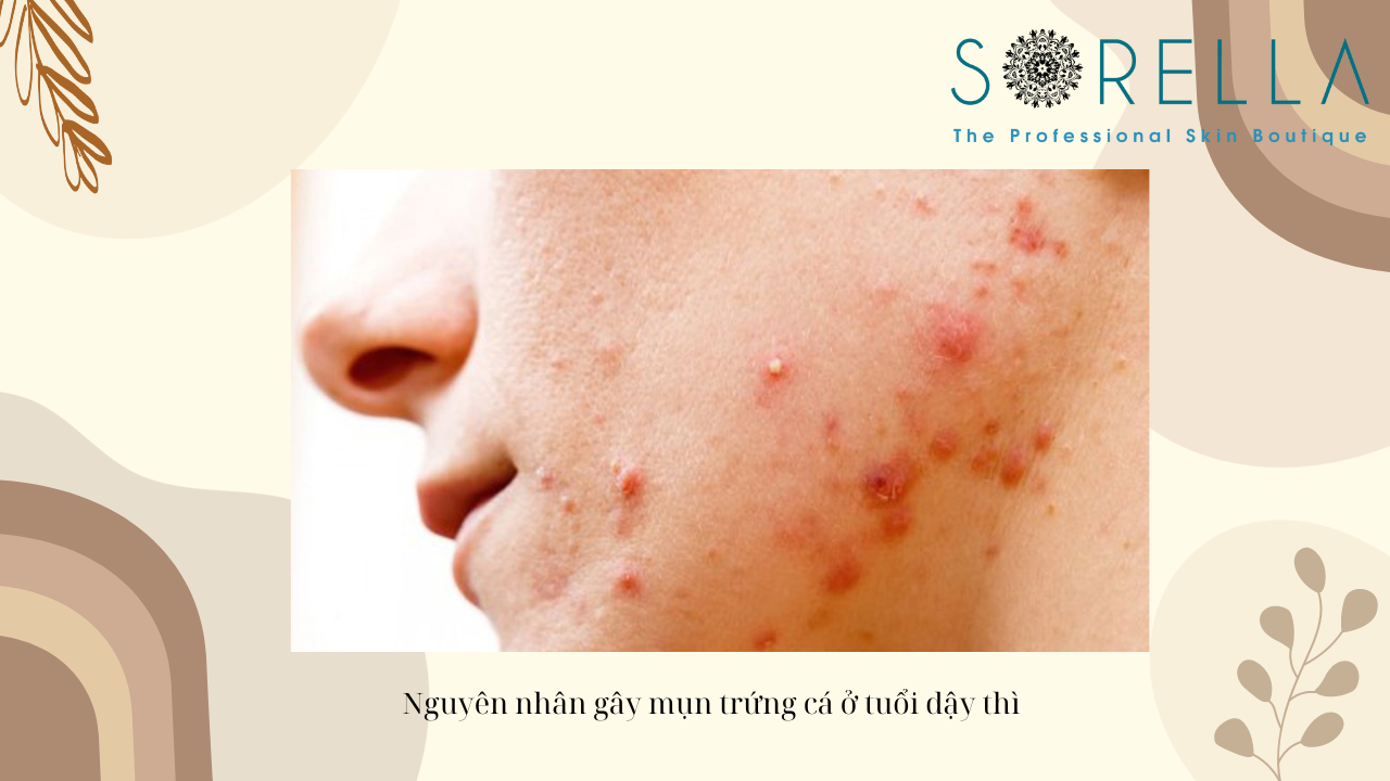Mụn trứng cá ở tuổi dậy thì là gì?