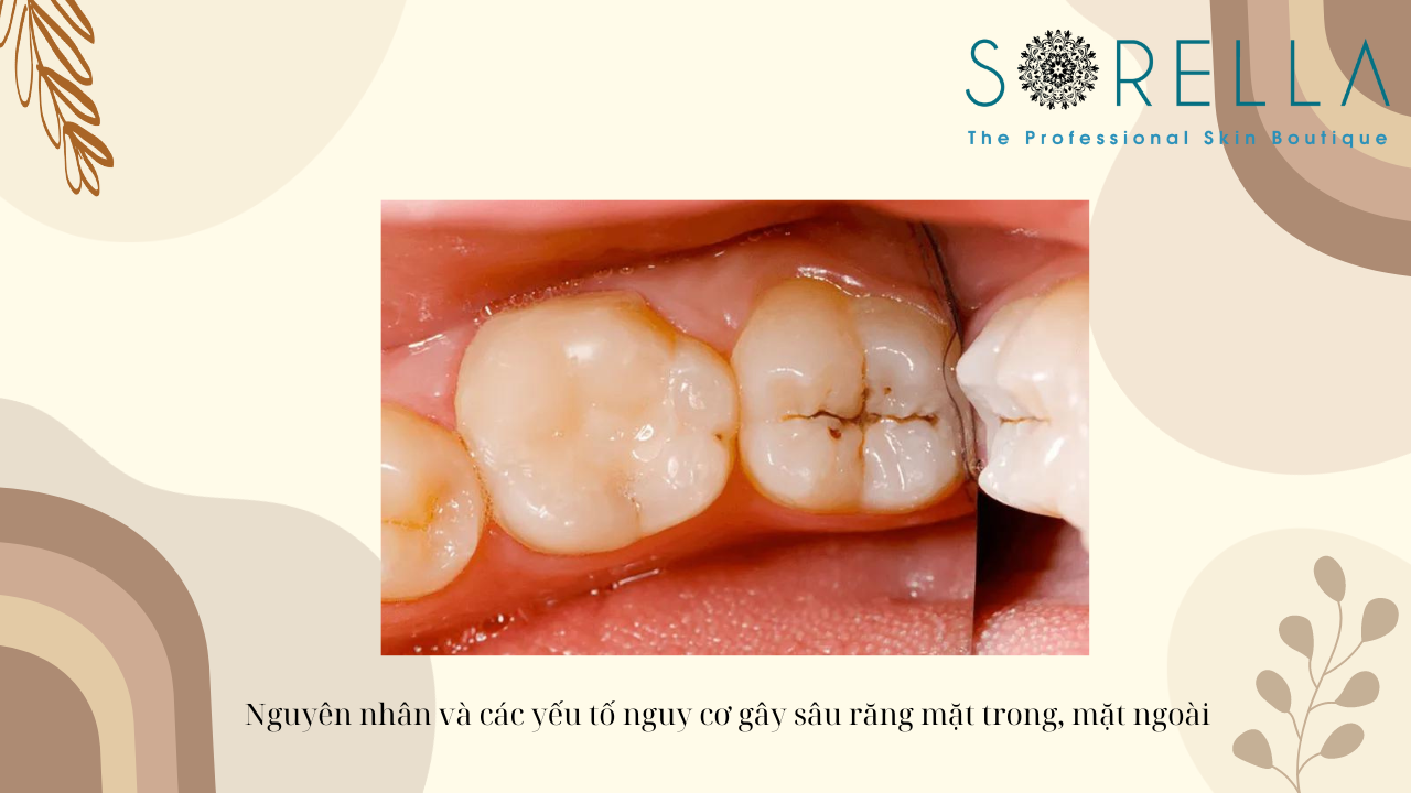 Sâu răng mặt ngoài- mặt trong