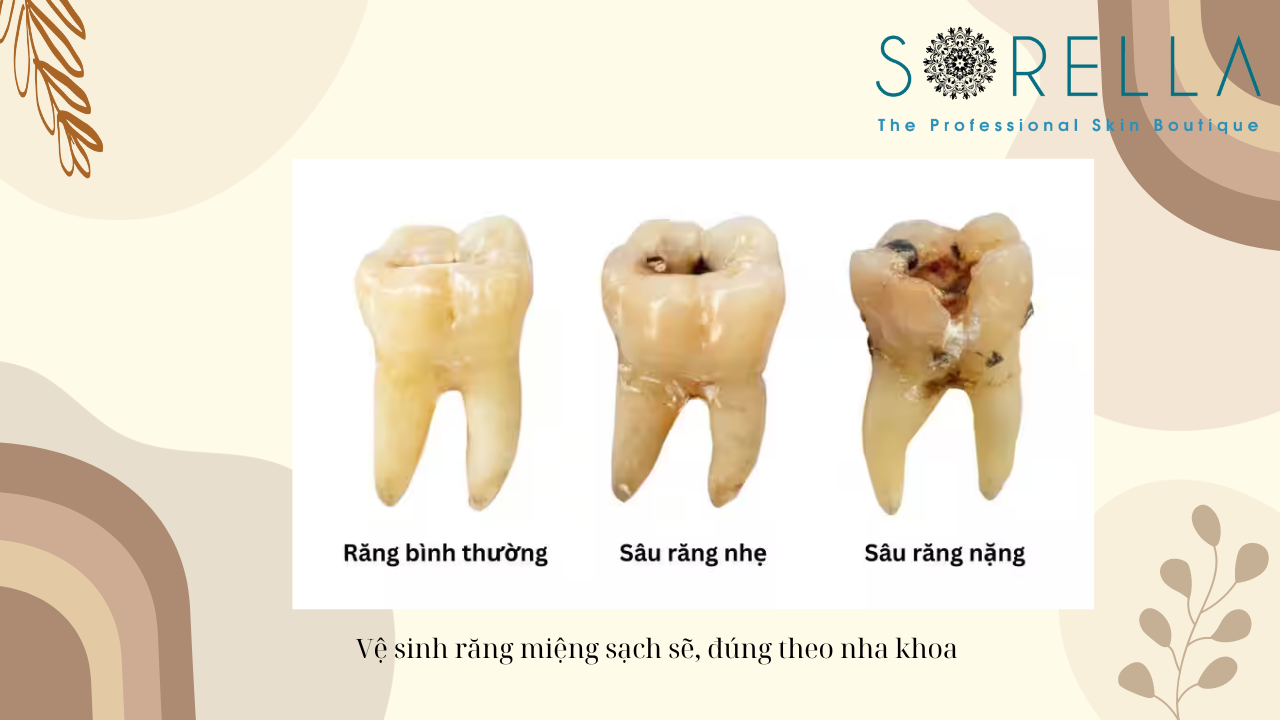 Sâu răng mặt ngoài- mặt trong