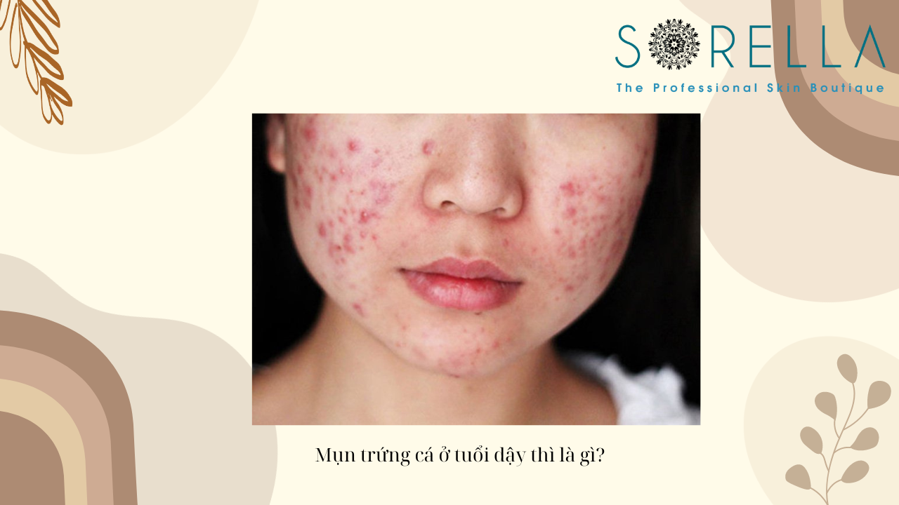 Mụn trứng cá ở tuổi dậy thì là gì?