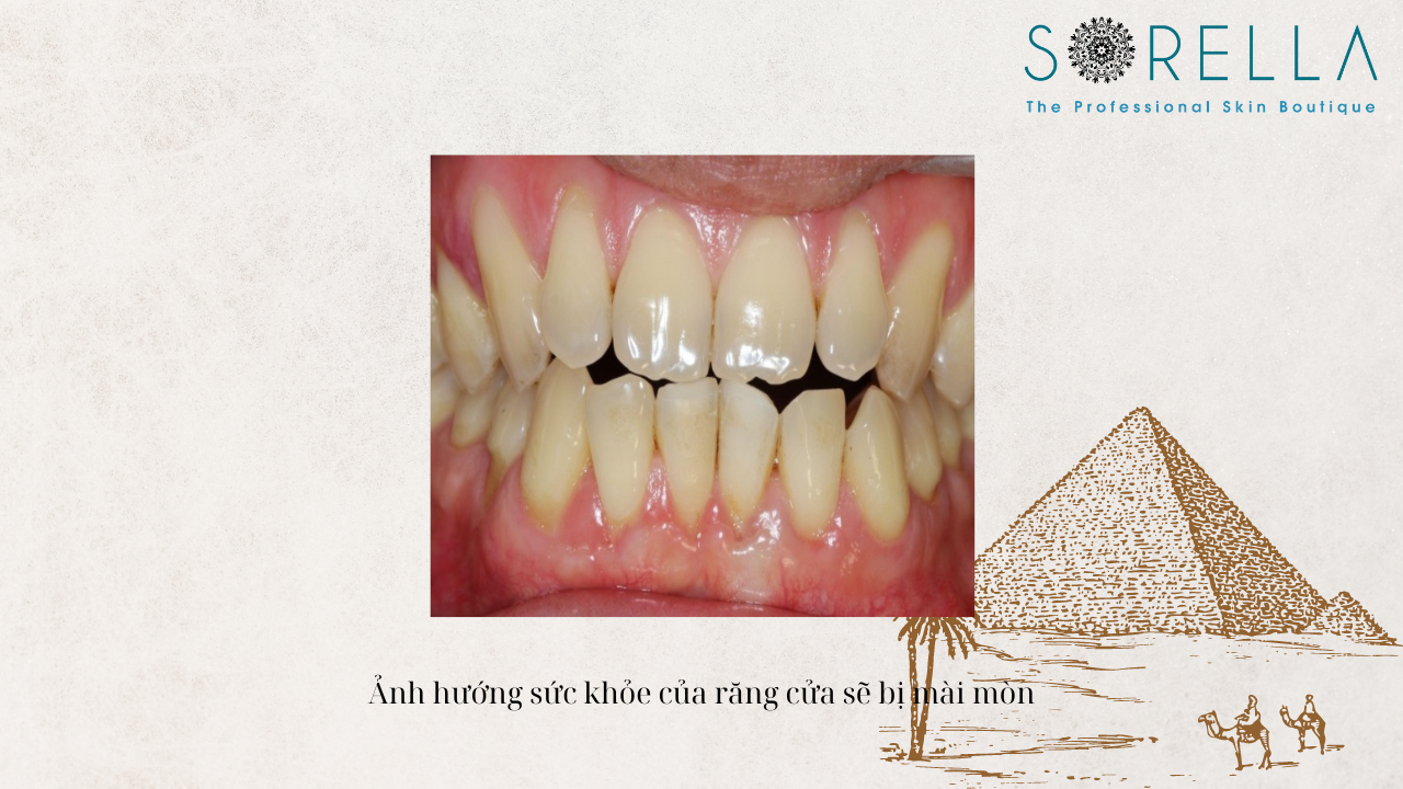 Khớp cắn đối đầu là gì?