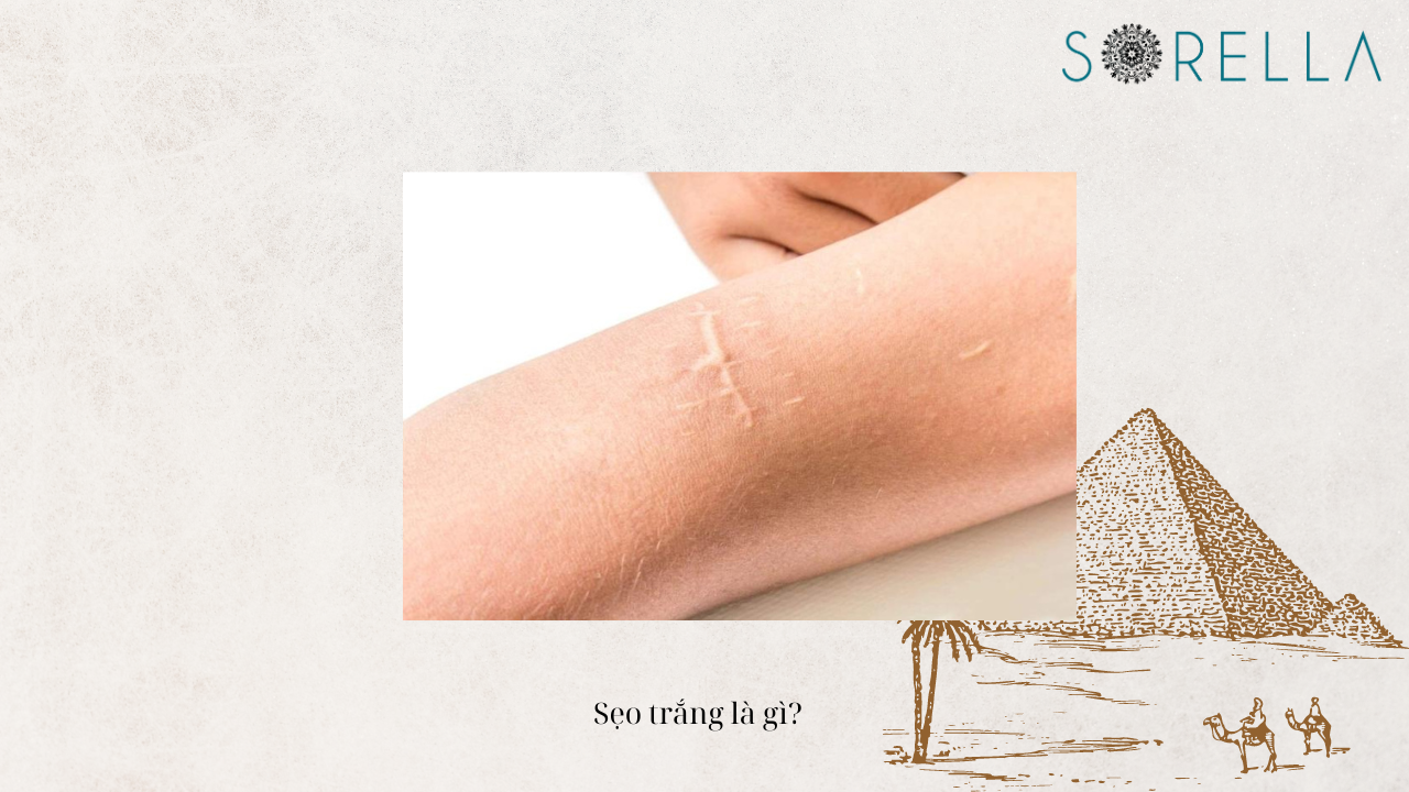 Sẹo trắng là gì?