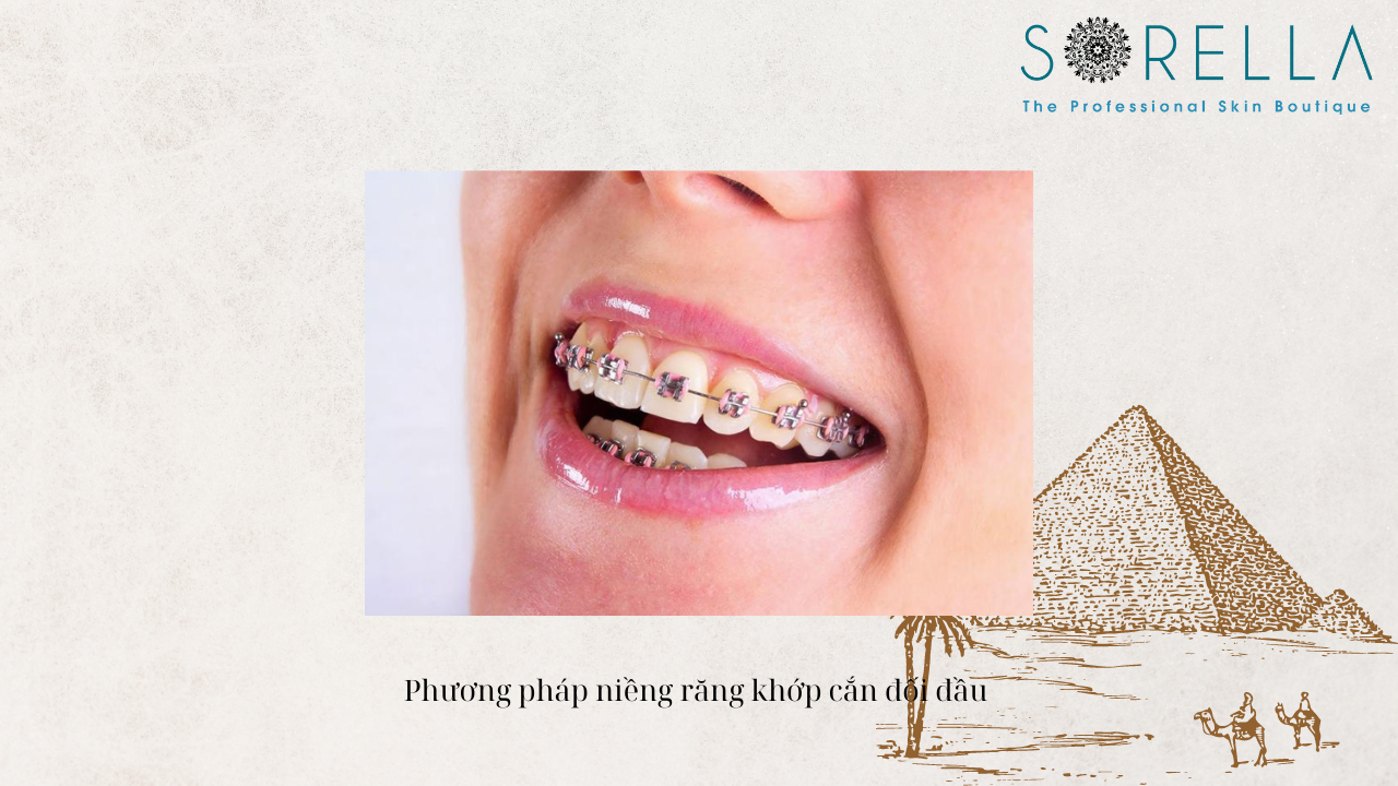 Khớp cắn đối đầu là gì?
